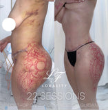20 Post Operative Massage / Body Sculpting Sessions